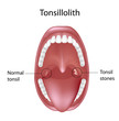 Tonsil stones, eps8