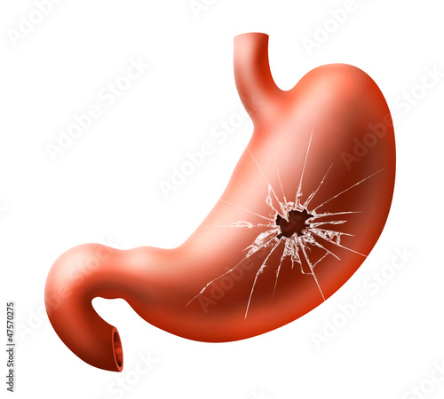 Illustration: An illustration of human stomach with problem An illustration of human stomach with problem