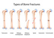 Types of bone fractures, eps8