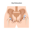Hip dislocation, eps10