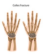 Colles fracture, eps8