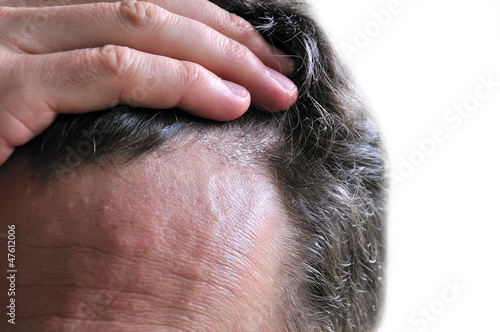 Photo: Dandruff, skin issue Dandruff, skin issue