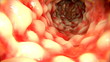 Morbus Crohn