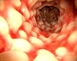 Morbus Crohn