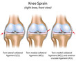 Knee sprain, eps8