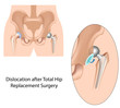 Dislocation after hip replacement surgery, eps10