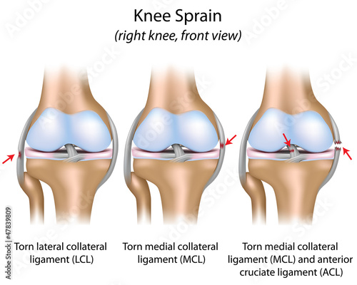 Vector: Knee sprain, eps8 Knee sprain, eps8