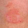 The wound on his leg
