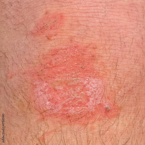 Photo: The wound on his leg The wound on his leg