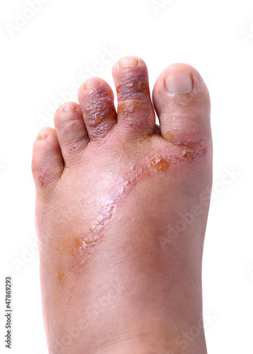 Photo: Wounds on women foot Wounds on women foot