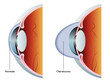 cheratocono