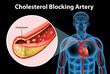 Ateriosclerosis