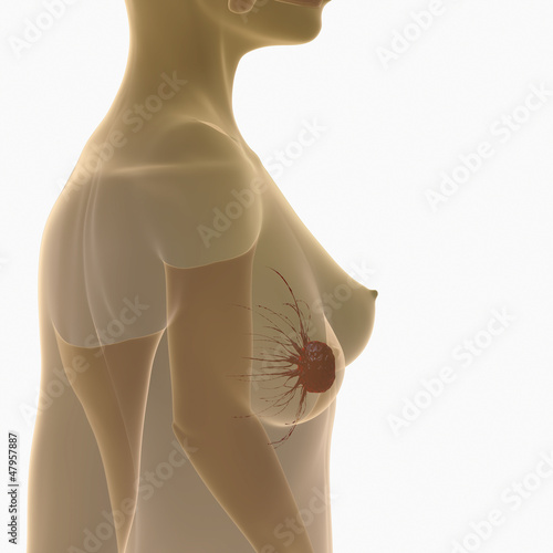 Illustration: breast cancer breast cancer