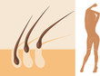 Epilation