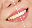 Photo: Whitening Whitening