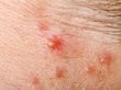 Pimple on human skin macro
