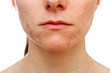 Adolescent girl suffering in acne