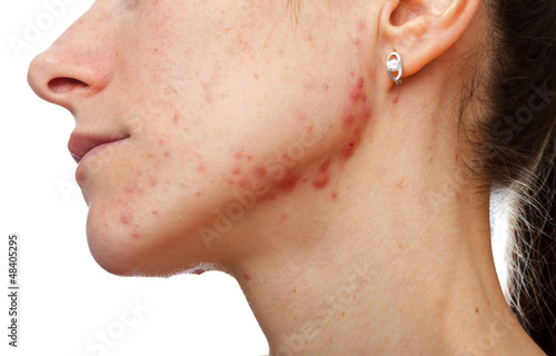 Photo: Young girl with skin problem Young girl with skin problem