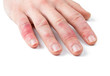 Dermatitis