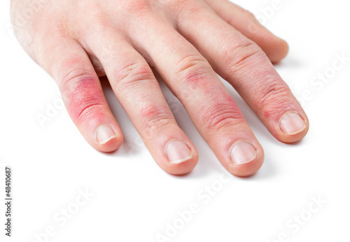 Photo: Dermatitis Dermatitis