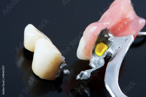 Photo: Part of a skeletal prosthesis - part of a series Part of a skeletal prosthesis - part of a series