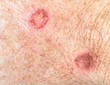 Skin cryotherapy