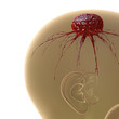 Hirntumor - 3D Render