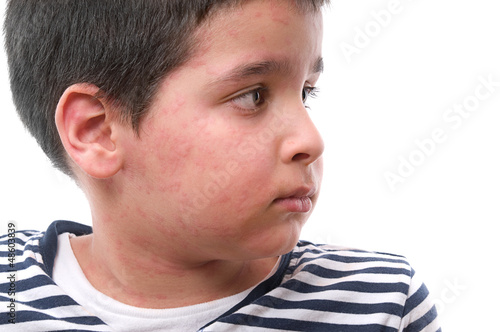Photo: Child with skin rash Child with skin rash
