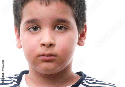 Photo: Child with urticaria Child with urticaria