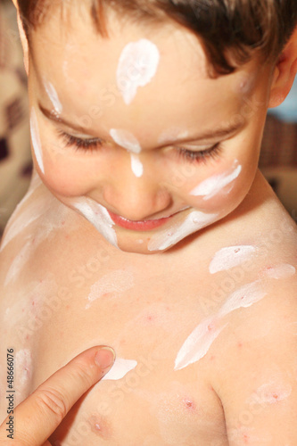 Photo: Baby with chicken pox rash with cream Baby with chicken pox rash with cream