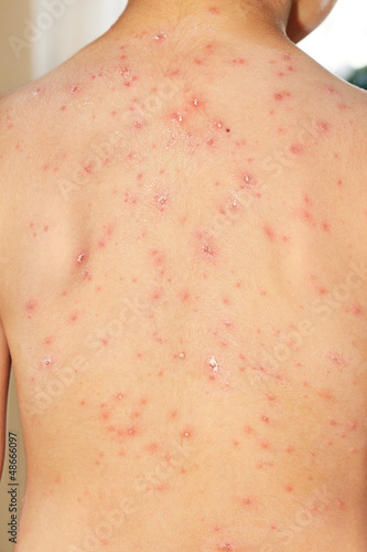 Photo: Baby boy with chicken pox rash Baby boy with chicken pox rash