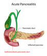 Acute Pancreatitis caused by gallstone, eps10