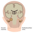 Acoustic Neuroma, eps10