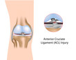 Anterior Cruciate Ligament injury, eps8