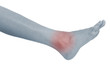 Acute pain in a woman ankle