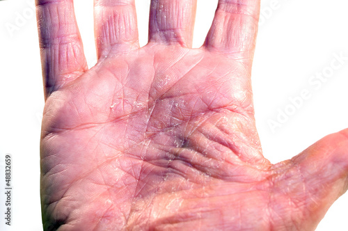 Photo: Handfläche links Krankheit Handfläche links Krankheit
