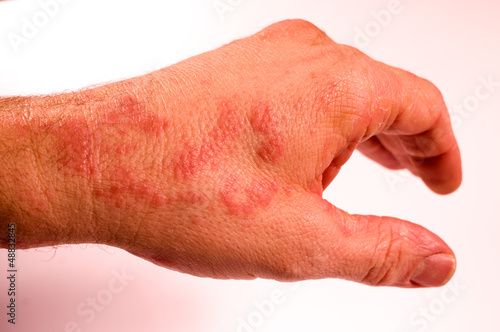 Photo: linke Hand erkrankt Ausschlag linke Hand erkrankt Ausschlag