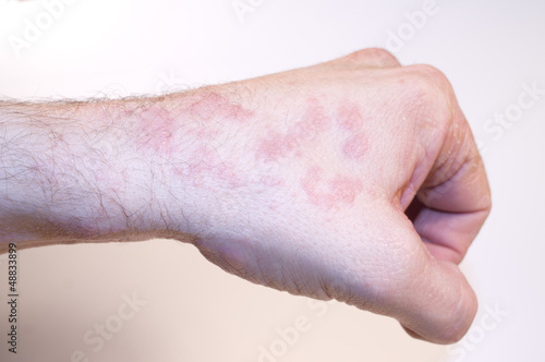 Photo: Hautkrankheit linke Hand Faust Hautkrankheit linke Hand Faust