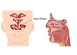 Nasal polyps, eps8