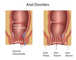 Anal disorders, eps8