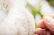 acupuncture