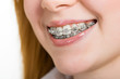 Photo: Beautiful young woman with brackets on teeth Beautiful young woman with brackets on teeth