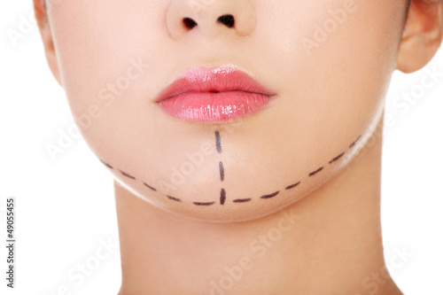 Photo: Woman marked out for cosmetic surgery. Woman marked out for cosmetic surgery.