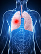 3d rendered illustration of the male lung - cancer