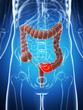3d rendered illustration of the male colon - cancer.