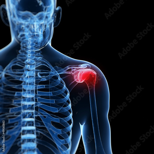 Illustration: 3d rendered illustration of a painful shoulder 3d rendered illustration of a painful shoulder