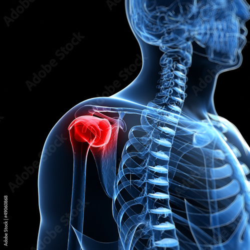 Illustration: 3d rendered illustration of a painful shoulder 3d rendered illustration of a painful shoulder