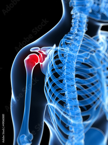 Illustration: 3d rendered illustration of a painful shoulder 3d rendered illustration of a painful shoulder