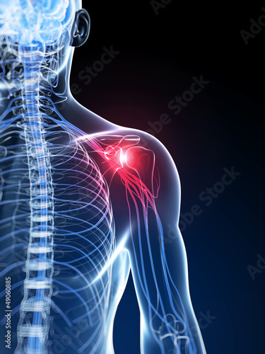 Illustration: 3d rendered illustration of a painful shoulder 3d rendered illustration of a painful shoulder