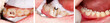 Tooth filling by dentist